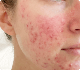 Close-up of inflammatory acne bumps and blemishes on the jawline. title.papulopustular.form