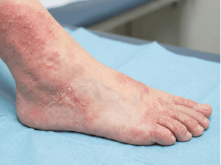 Close-up of localized skin peeling and scaling on a finger /images/dermatitis/trail-11.png