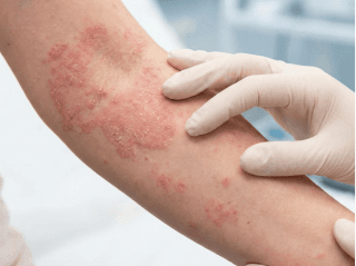 Medical professional inspecting a raised, scaly rash on an arm /images/dermatitis/trail-7.png