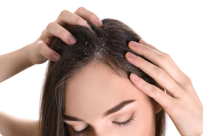 Seborėjinis dermatitas: riebus, gelsvas pleiskanojimas ir paraudimas antakiuose bei šonuose prie nosies